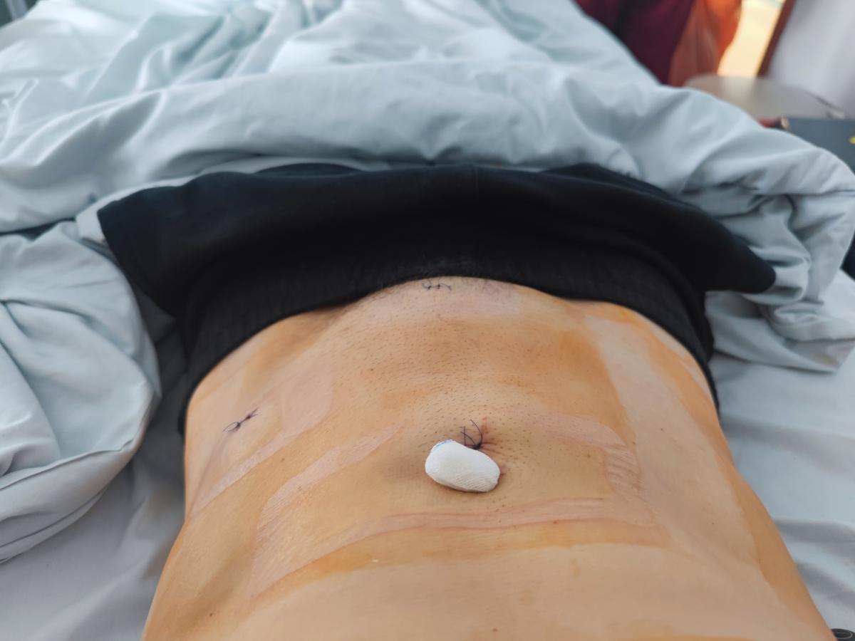 colonoscopy