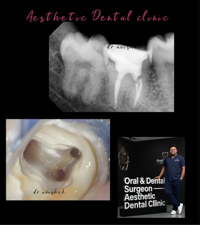 ##rootcanaltreatment 
#endodontics